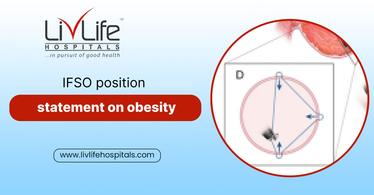 IFSO position statement on obesity ..