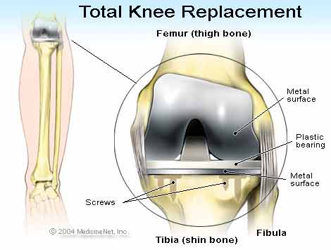 Rise in Number of Total Knee Replacement Surgeries and Obesity