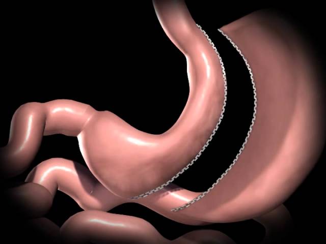 GASTRIC SLEEVE RESECTION SURGERY