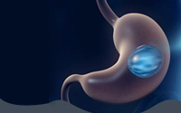 GASTRIC IMBRICATION SURGERY