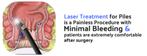 Laser Treatment for Piles is a painless procedure