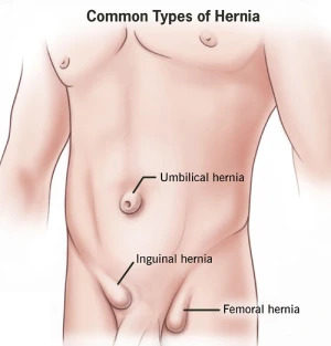 Hernia Surgery Hospital in Hyderbad