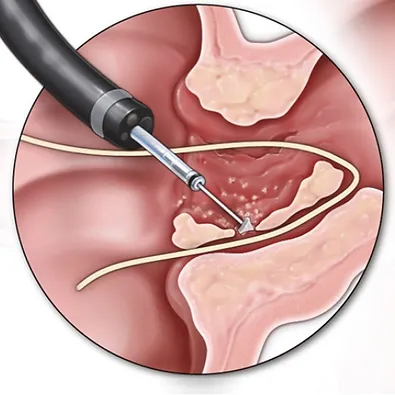 Fistula