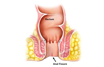 Fissure Surgery in Hyderabad