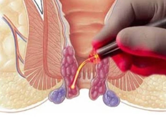 Fissure Laser Treatment