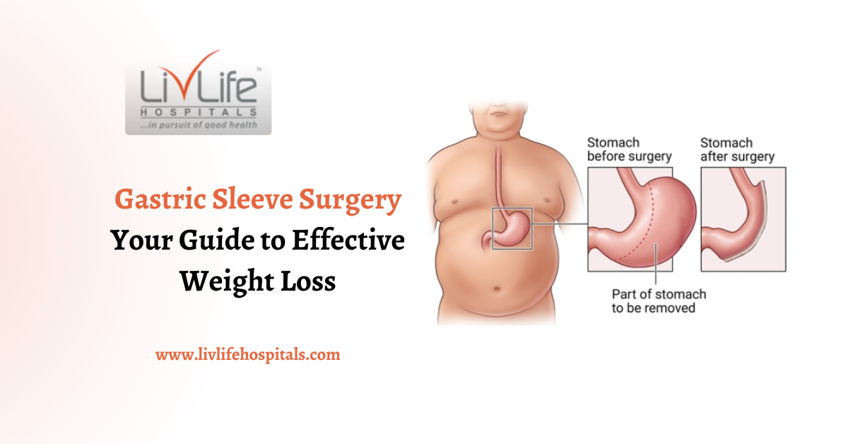 Gastric Sleeve Surgery: Your Guide to Effective Weight Loss