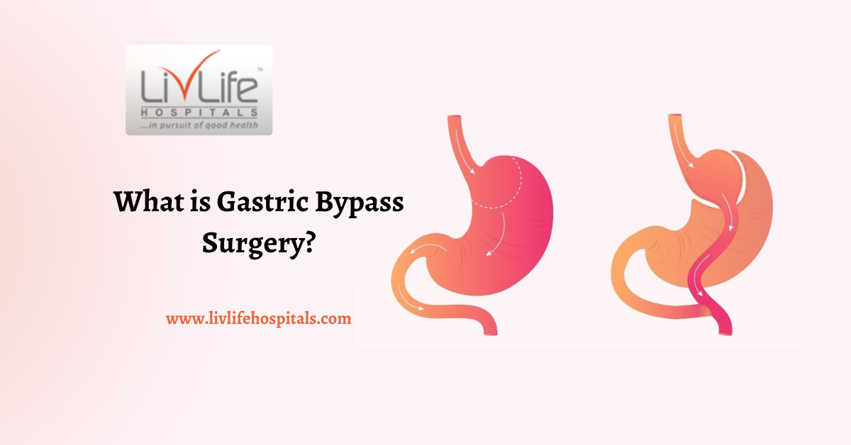 What is Gastric Bypass Surgery?