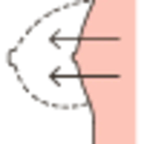 Breast-Enhancement
