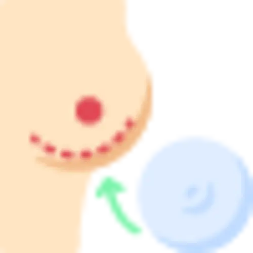 Breast Implants