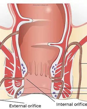 fistula-surgery