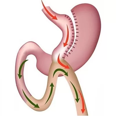 Mini Gastric Bypass